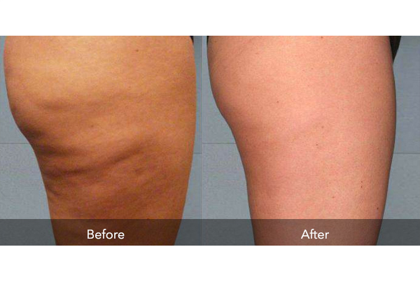 Cellulite Reduction